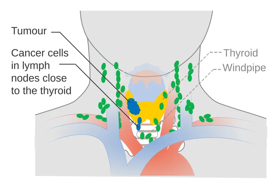 Diagram showing stage N1a thyroid cancer.