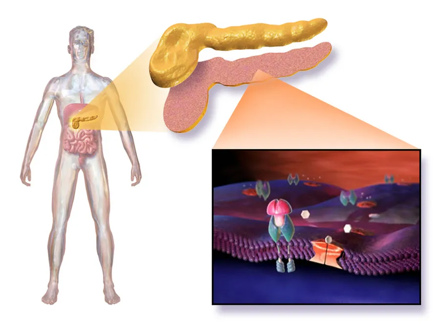 Type 1 Diabetes.