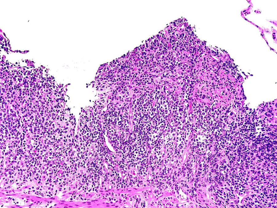 Histopathology of severe ulcerative colitis, hematoxylin and eosin stain: Colonic mucosa showing ulceration with replacement of the normal crypt architecture above the muscularis (seen at bottom) by granulation tissue, a