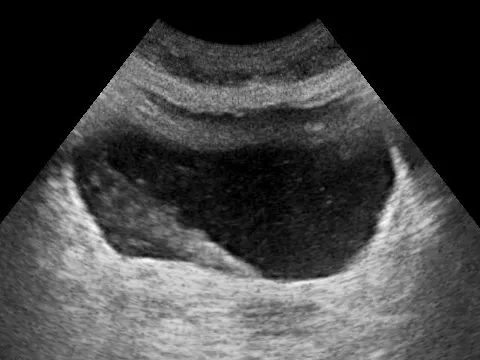 Ultrasound demonstration of ureteral jet effect