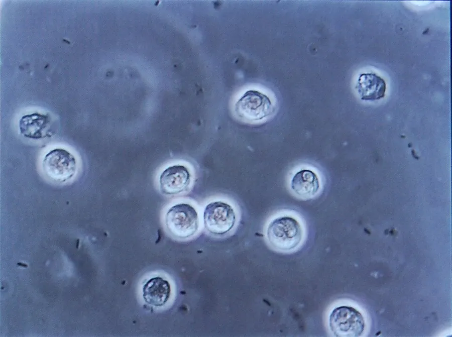 Bacteriuria and pyuria demonstrated at urinary microscopy.