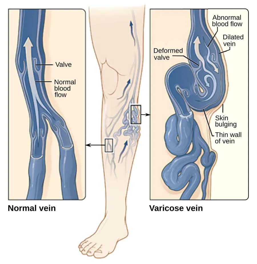 Varicose veins