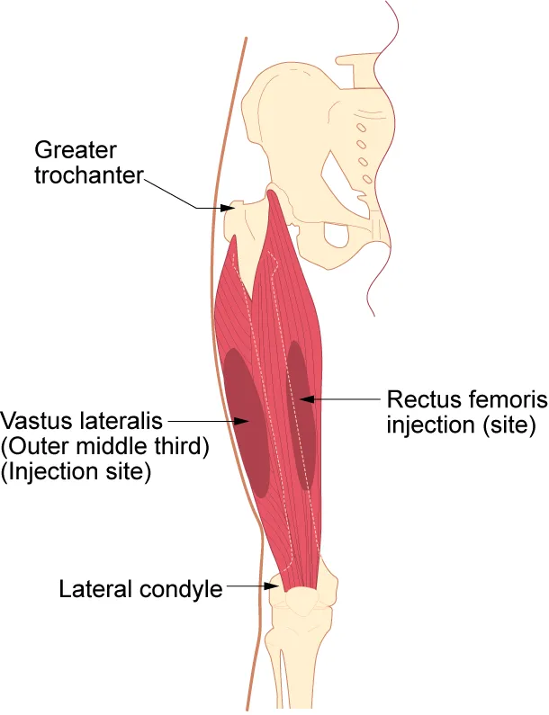 Vatus lateralis site and rectus femoris site for intramuscular (IM) injection